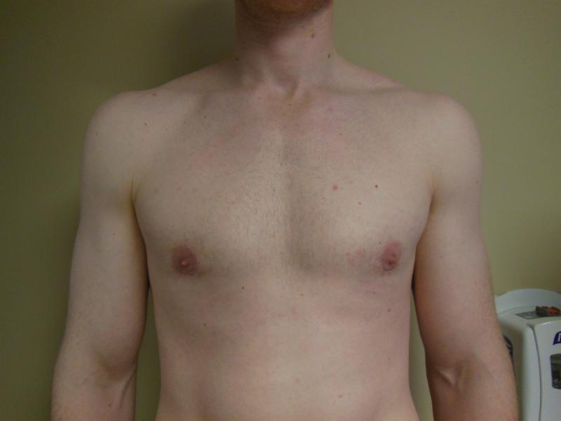 Male patient after gynecomastia 