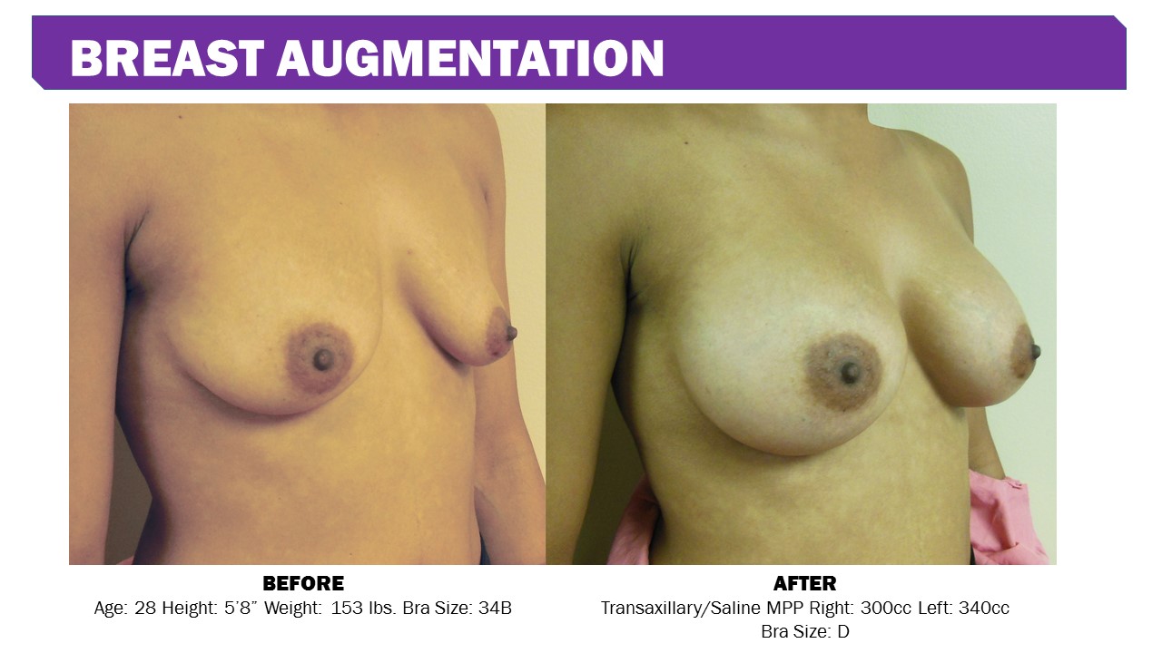 abdominoplasty abdominoplasty