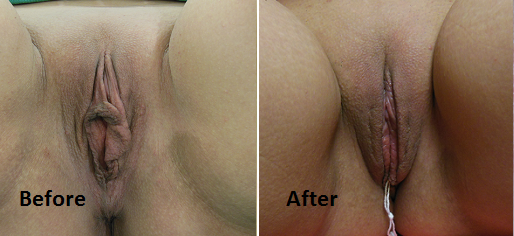Labiaplasty Labiaplasty