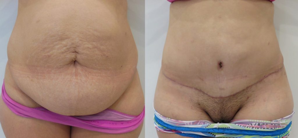 Tummy tuck actual patient results