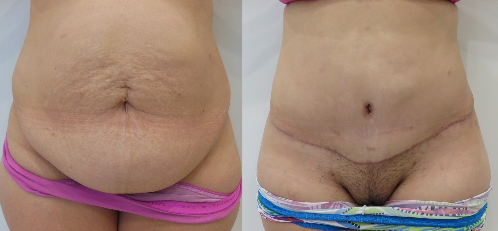 Tummy Tuck actual patient results