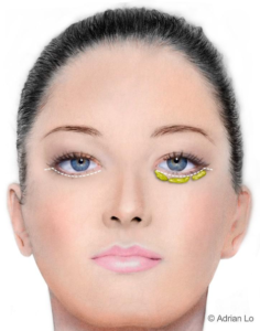 Illustration: The Traditional Lower Eyelid Incision - Female