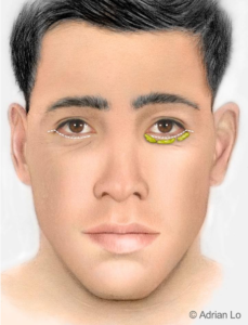 Illustration: The Traditional Lower Eyelid Incision - Male