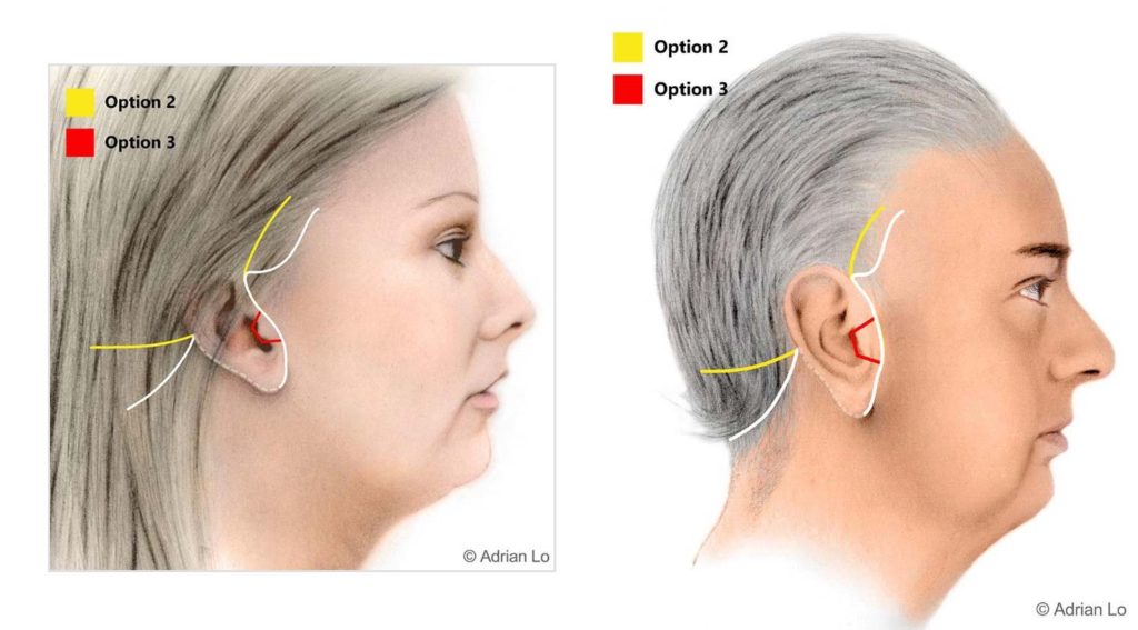 Facelift Illustration: Option 1
