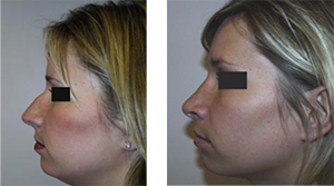 Nose Surgery before and after photo | Dr. Adrian Lo