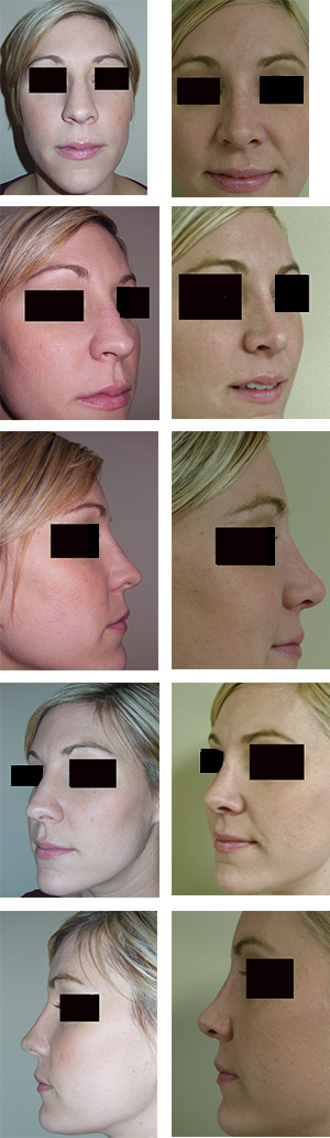 Before and After Rhinoplasty by Dr. Adrian Lo