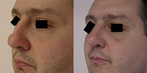 Male Rhinoplasty Before and After | Dr. Adrian Lo