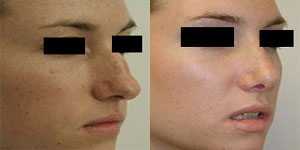 Before and After Rhinoplasty by Dr. Adrian Lo