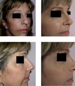 Nose Surgery before and after photo | Dr. Adrian Lo