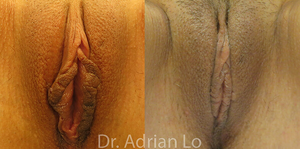 Labiaplasty patient Before and after number 2 Results may vary