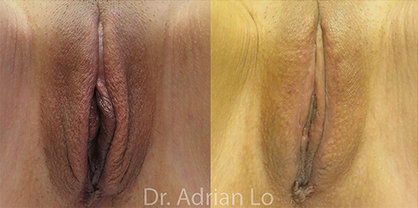 Labiaplasty patient Before and after number 3 Results may vary