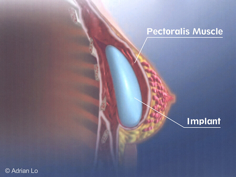 Implant placement below the muscle