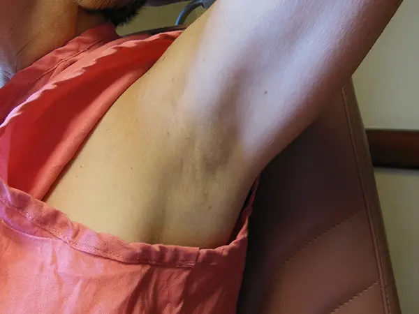 Breast Augmentation Armpit incision results 2