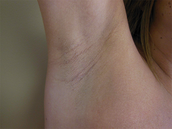 Breast Augmentation Armpit incision results 3