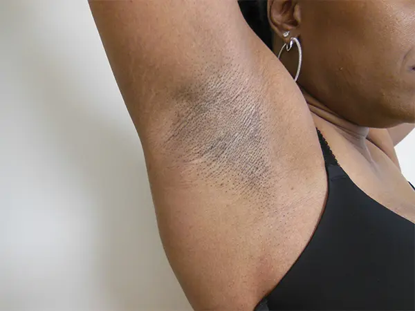 Armpit incision results