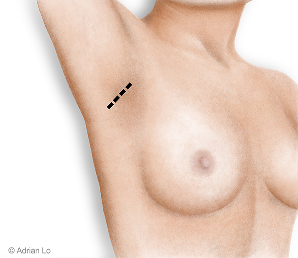 Breast Aug armpit incision