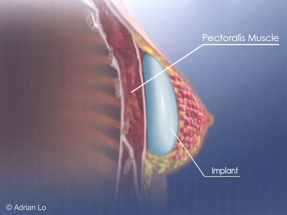 Implant placement above the muscle