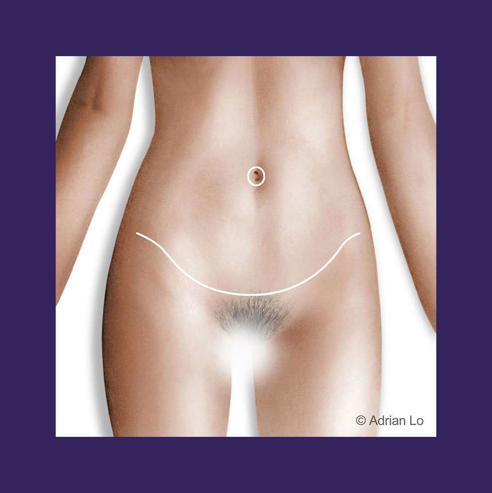 Graphic of a tummy tuck scar line