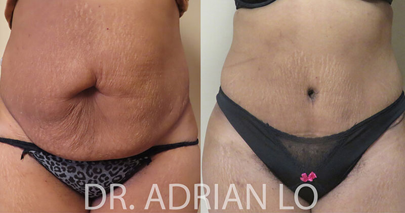 Actual patient results tummy tuck