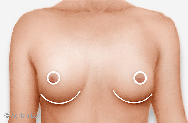 Breast procedure incision location