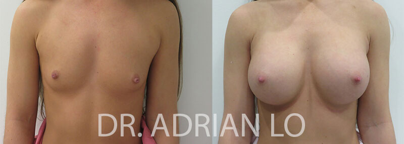 Breast Augmentation actual patient results