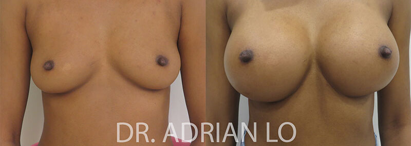 Breast Augmentation actual patient results 3