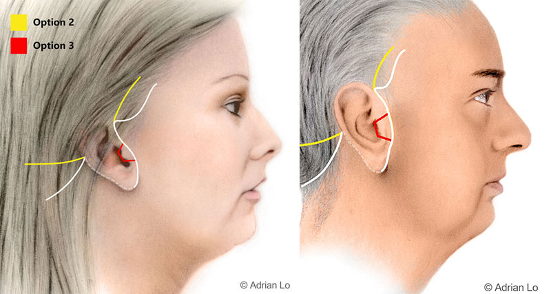 Diagram of a facelift procedure