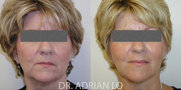 Facelift actual patient results