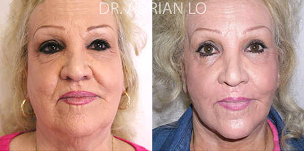 Facelift actual patient results 2