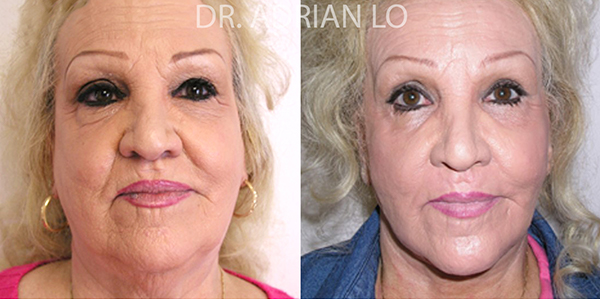 Facelift actual patient results 2