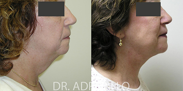 Facelift actual patient results 2