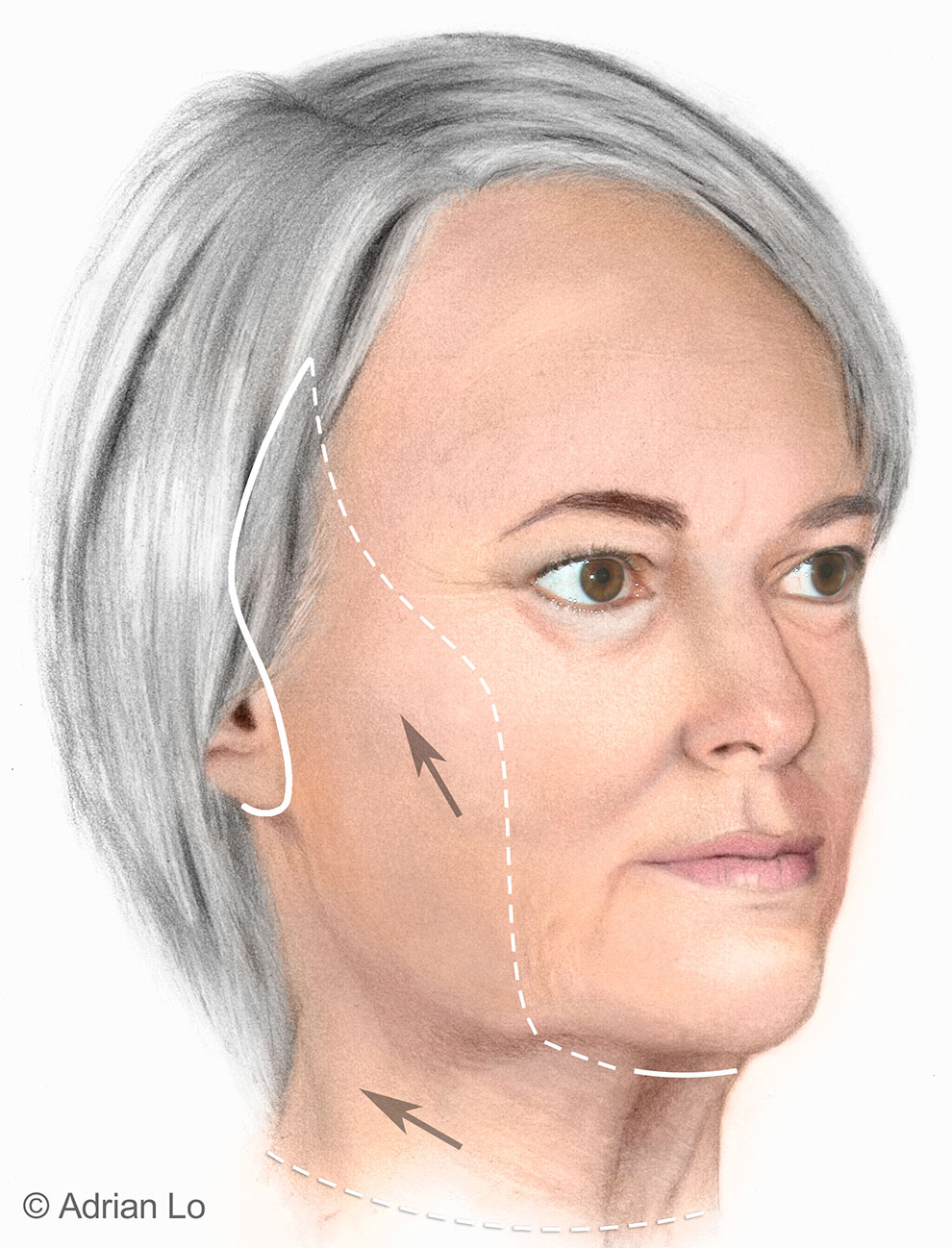 DIRECTION OF SKIN TIGHTENING DURING A FACELIFT PROCEDURE