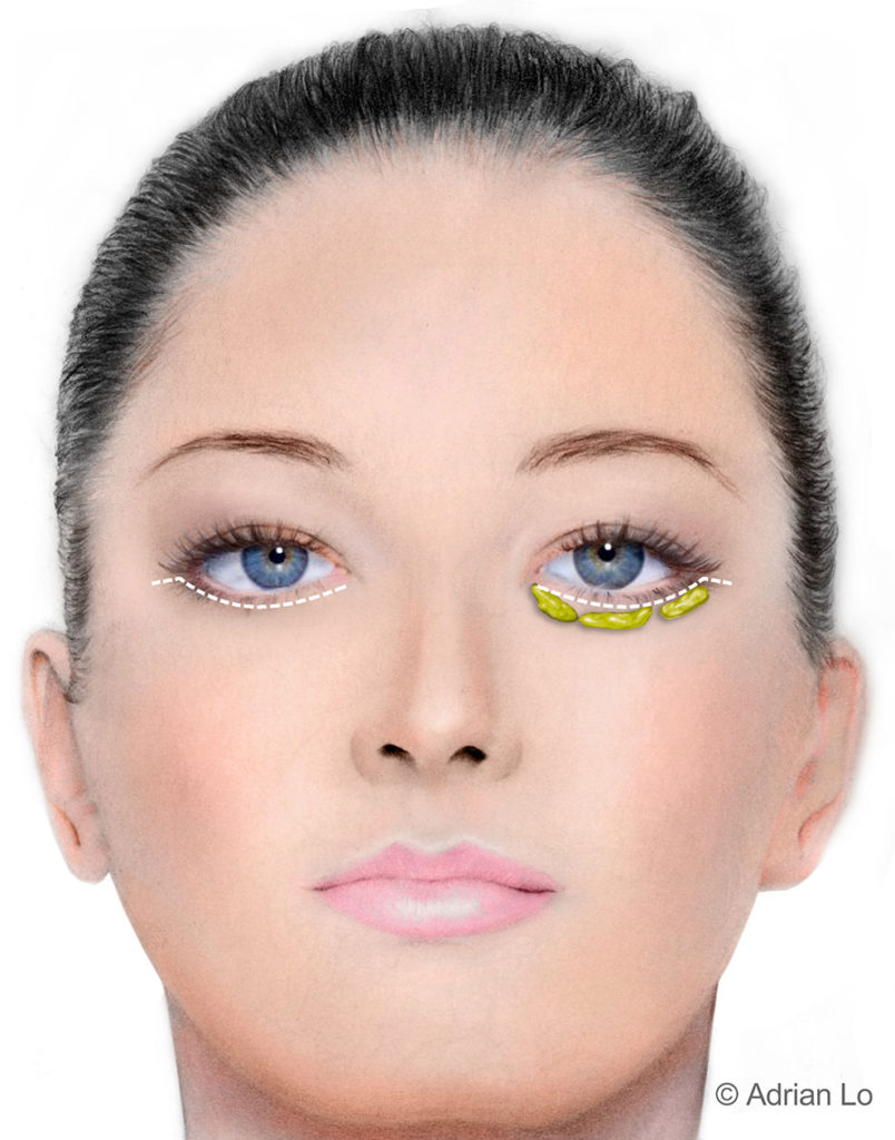 Lower eyelid procedure diagram