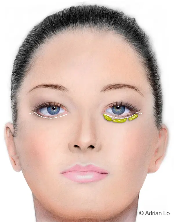 Diagram of lower eyelid surgery