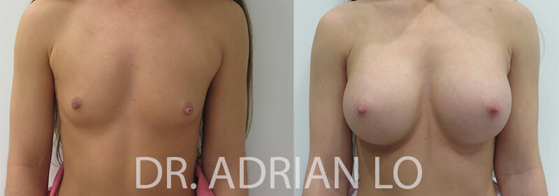 Breast Augmentation patient Before and after number 1 Results may vary