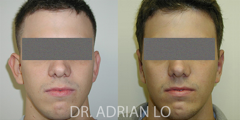 Otoplasty actual patient results