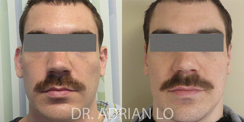 Otoplasty actual patient results 2