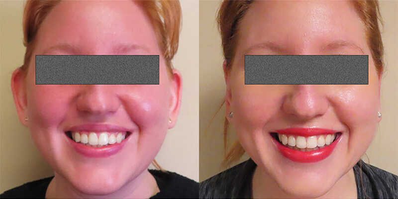 Otoplasty actual patient results 3