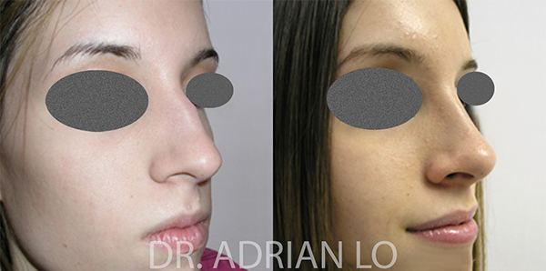 Rhinoplasty actual patient results 2