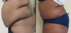 Tummy tuck patient Before and after number 2 Results may vary