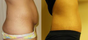 Tummy tuck patient Before and after number 1 Results may vary