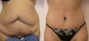 Tummy tuck patient Before and after number 3 Results may vary