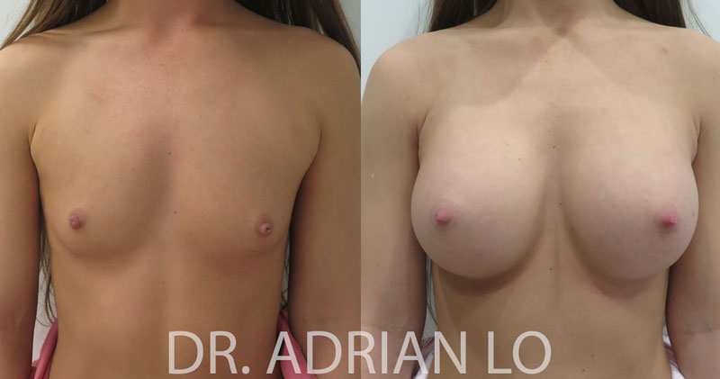 Breast Augmentation Patient