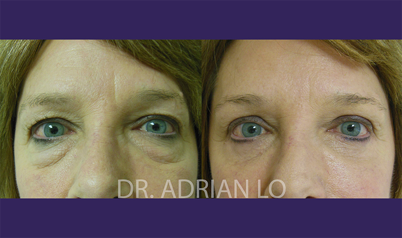 Brow Lift actual patient results 3