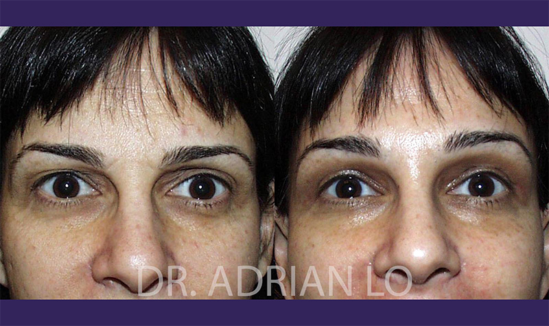 Brow Lift actual patient results 2