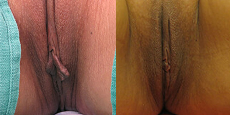 labia actual patient results