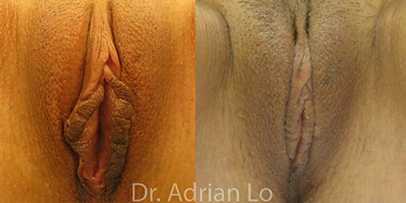 Labiaplasty actual patient results 3