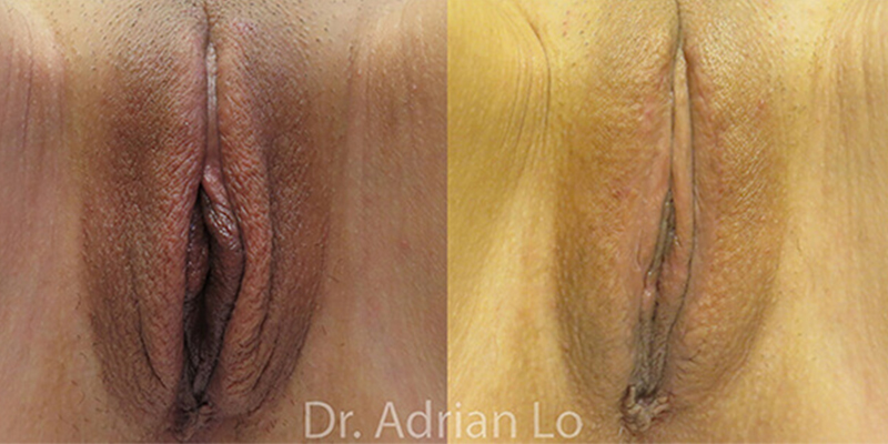 Labiaplasty actual patient results