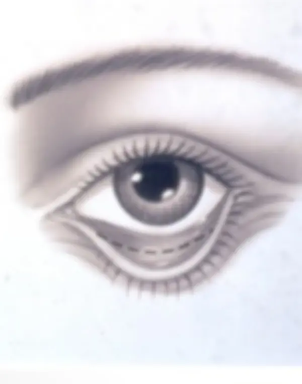 Eye with lower eyelid incision