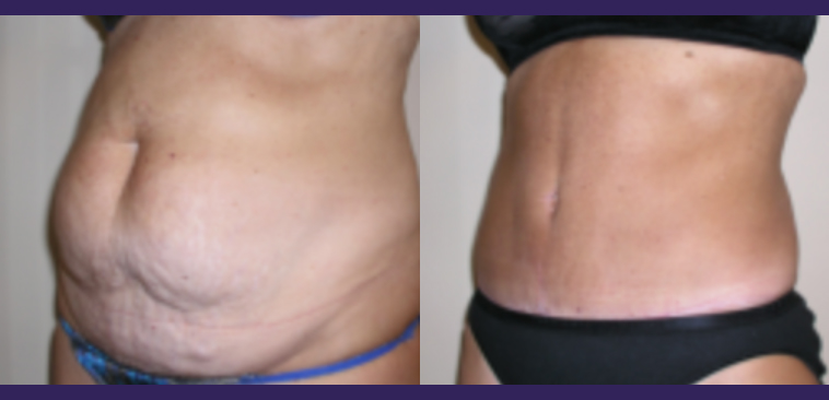 Tummy Tuck Before and After results